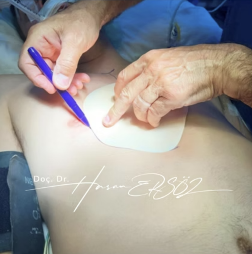 3D Silicone Implant Surgery Process 3D Silicone Implant Surgery Process