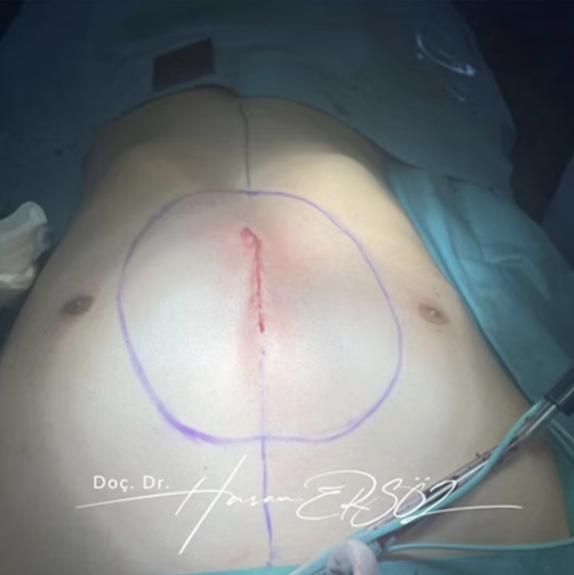 3D Silicone Implant Surgery Process 3D Silicone Implant Surgery Process