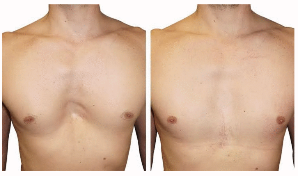 Image of a patient with pectus excavatum improved by placing a 3D silicone implant Image of a patient with pectus excavatum improved by placing a 3D silicone implant
