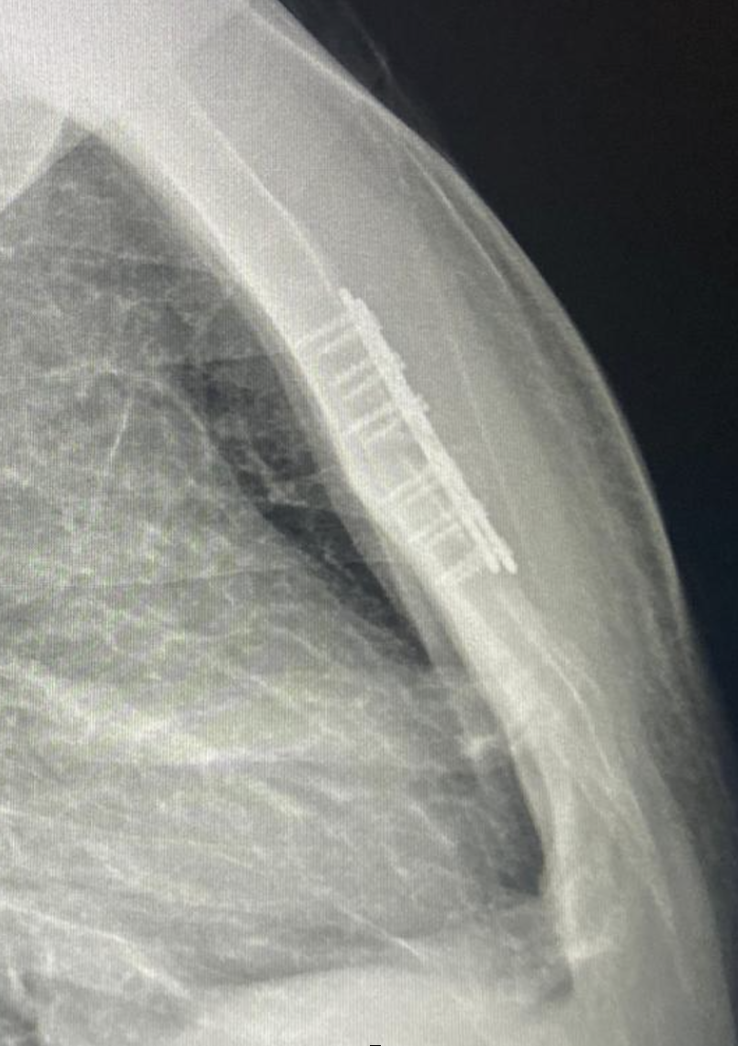 Ravitch Procedure - DR Pectus