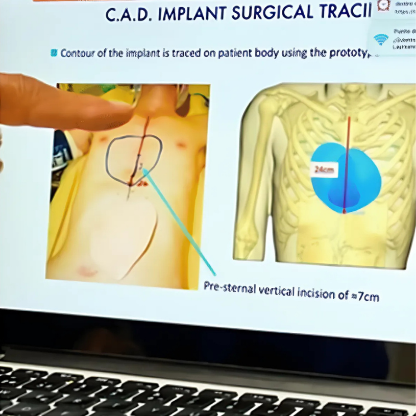 3D Silicone Implant Surgery Education Process 3D Silicone Implant Surgery Education Process
