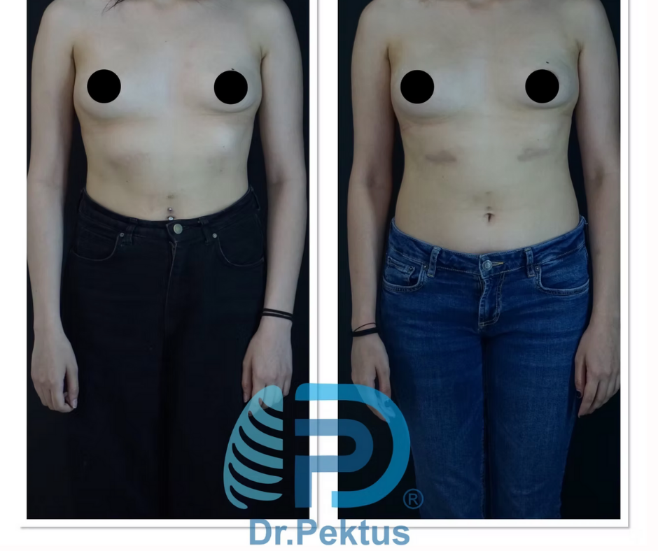 Kıkırdak kaburga çıkarılmasıyla rib flare düzeltilmesi svg+xml;charset=utf