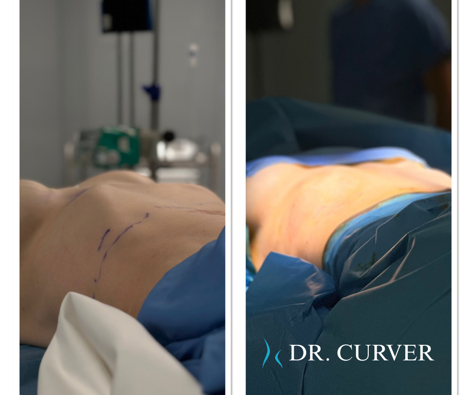 Ribellayla ameliyat anında izsiz rib flare düzeltme svg+xml;charset=utf